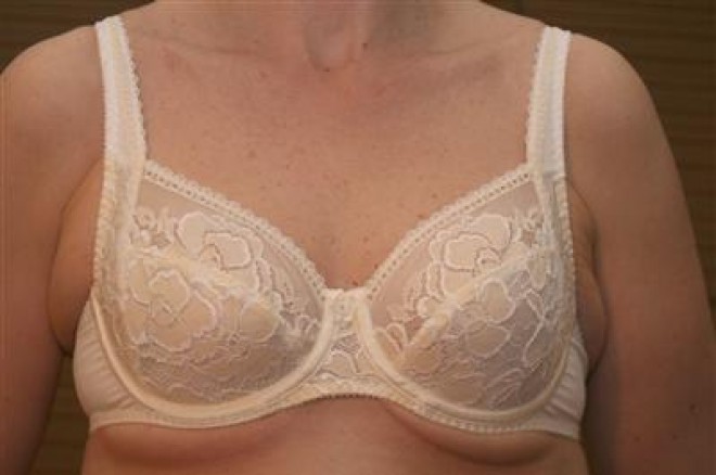 bad bra fitting symptoms